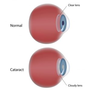Cataract chart
