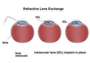 diagram of refractive lens exchange 