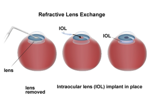 refractive lens exchanges