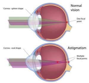 anatomic diagram of astigmatism in the eye