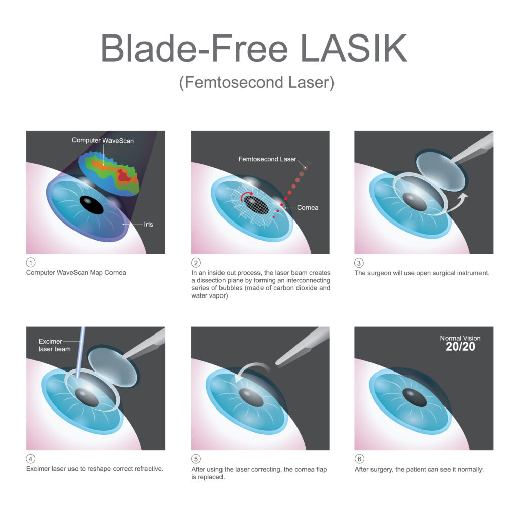 Blade Free LASIK with the Femtosecond Laser