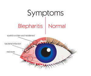 blepharitis