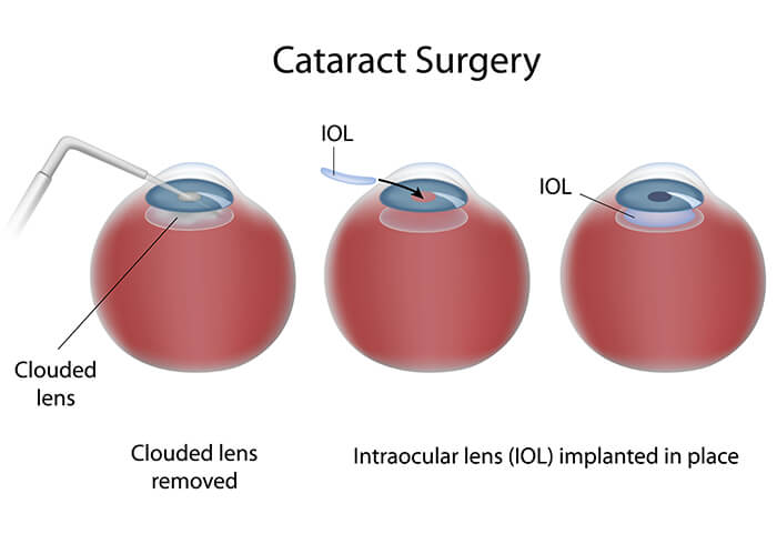 Cataract Surgery Boston Cataract Surgery Diagram