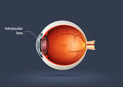Intraocular Lens Graphic