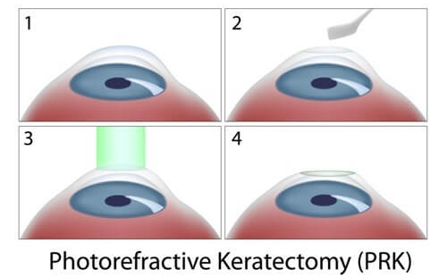 PRK Surgery Diagram