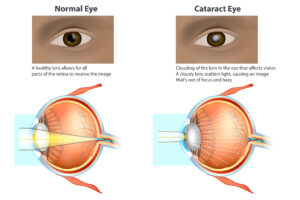 diagram of a normal eye and an eye with cataracts