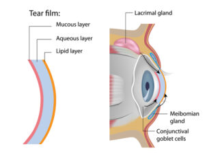 diagram of dry eye